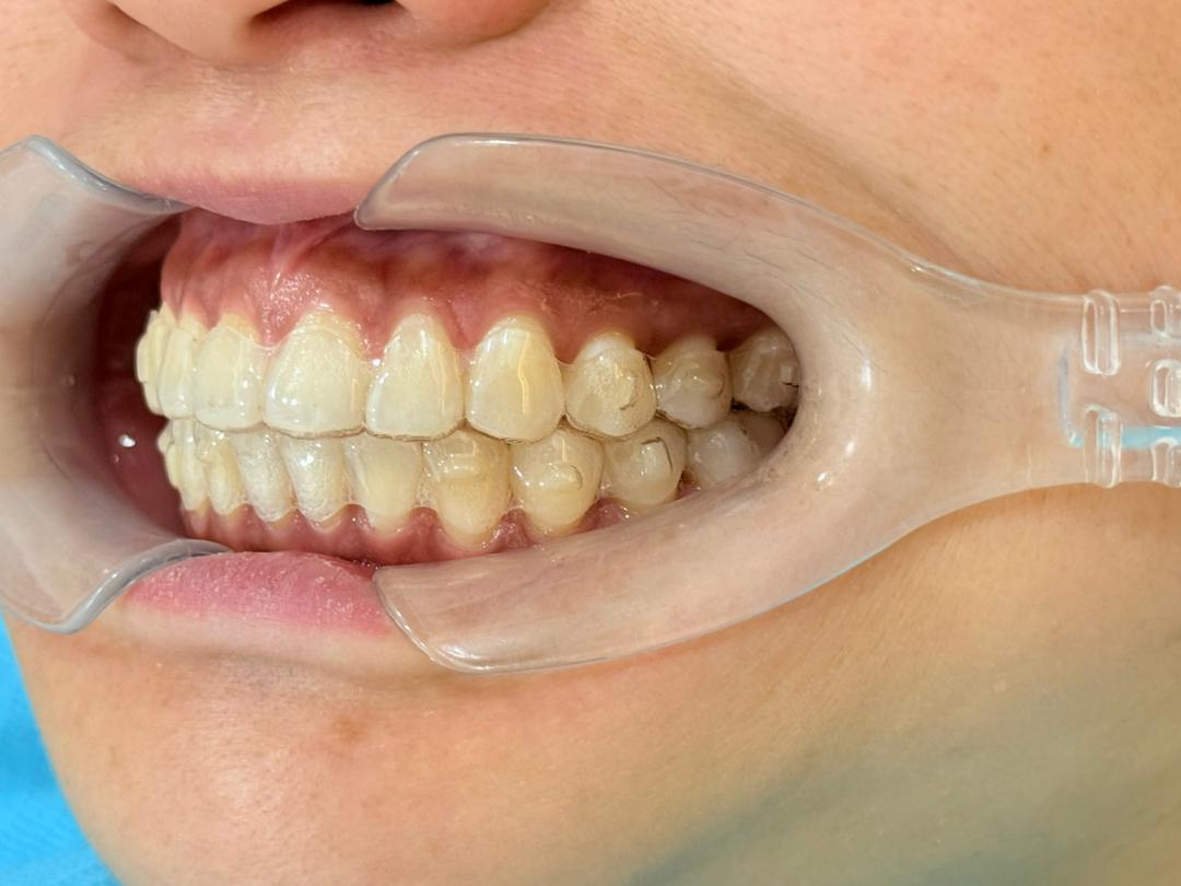 Clear aligner worn on teeth during treatment, left side view