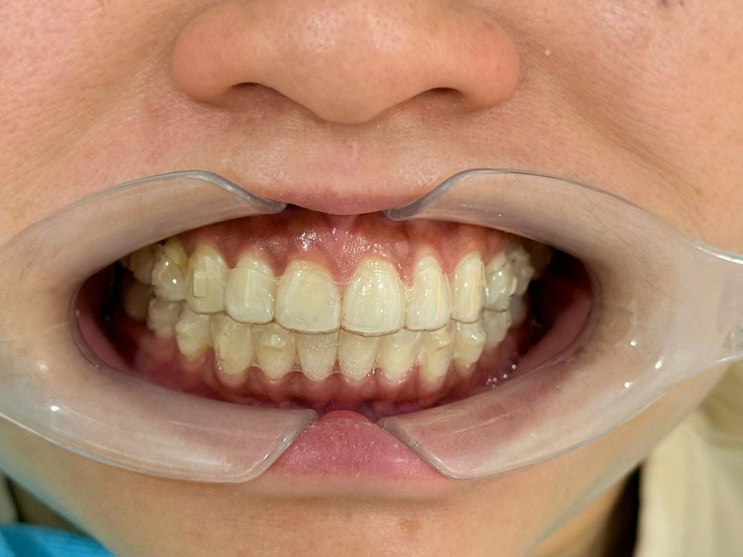 Clear aligner worn on teeth during treatment, front view