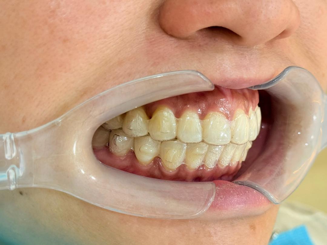 Clear aligner worn on teeth during treatment, right side view