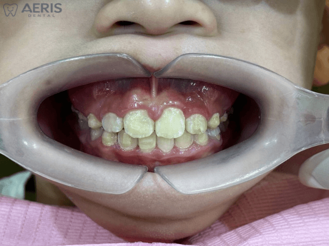 After 9 months of clear aligner treatment showing improved tooth alignment