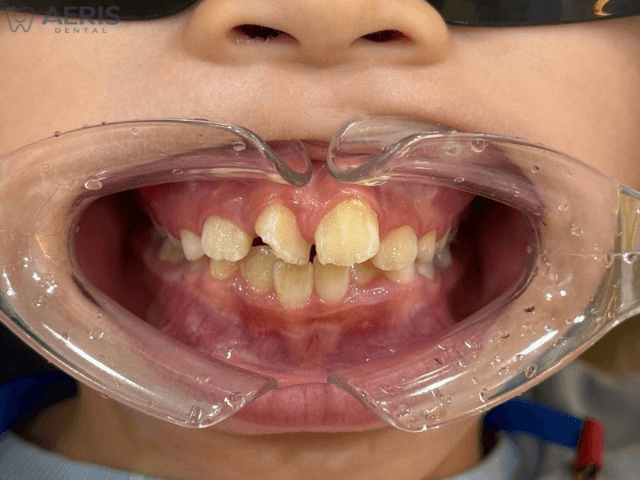 Before clear aligner treatment showing dental crowding