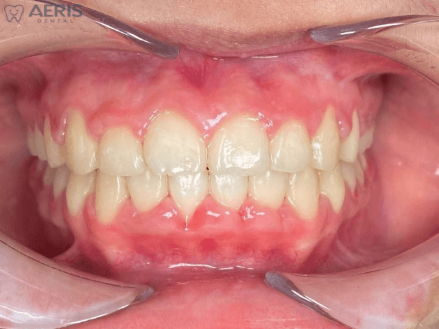 After 12 months of clear aligner treatment for an overbite concern