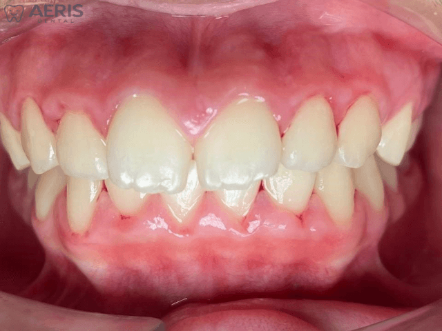 Before clear aligner treatment showing an overbite concern