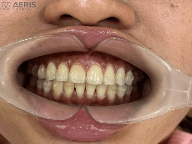 After 8 months of clear aligner treatment showing improved spacing and alignment