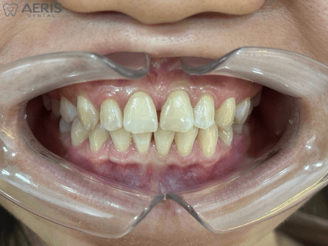 Before clear aligner treatment showing spacing between teeth